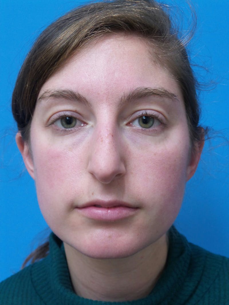 Rhinoplasty Before & After Gallery - Patient 172312 - Image 5