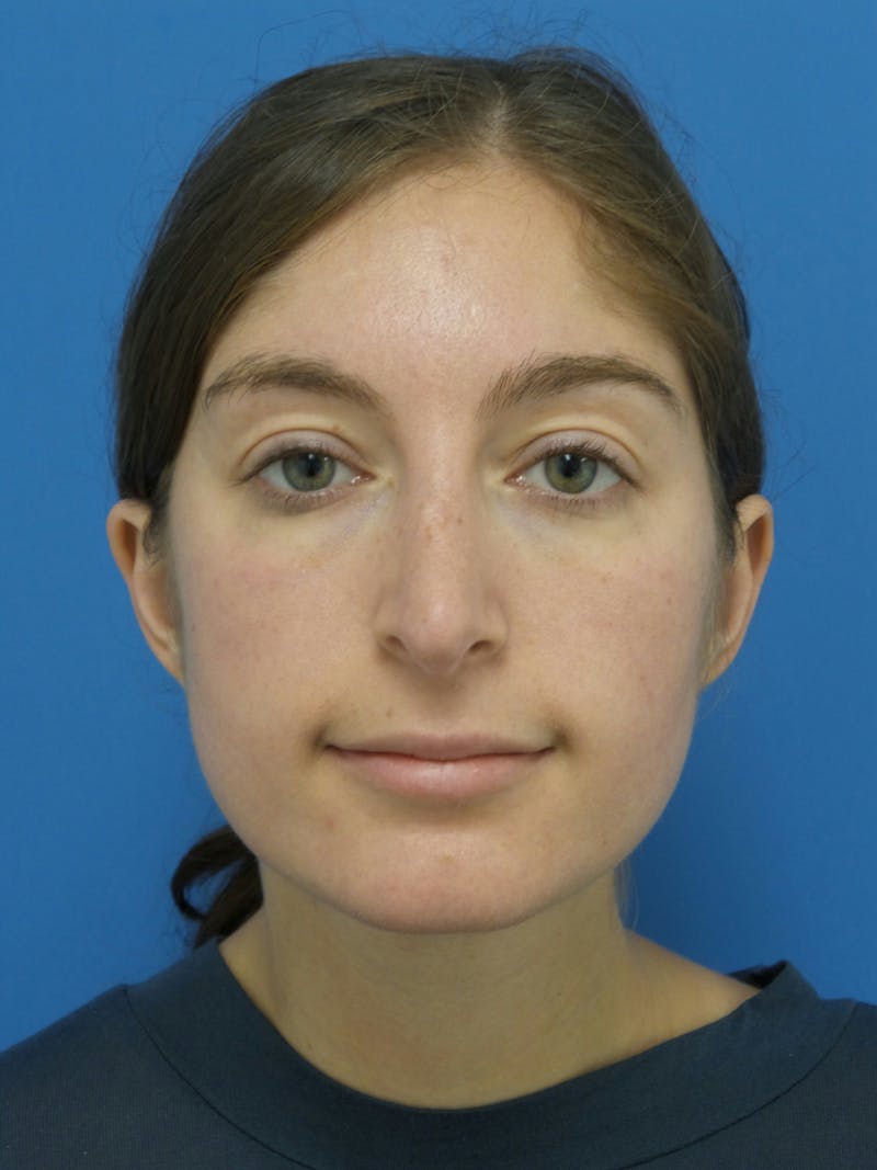 Rhinoplasty Before & After Gallery - Patient 172312 - Image 6