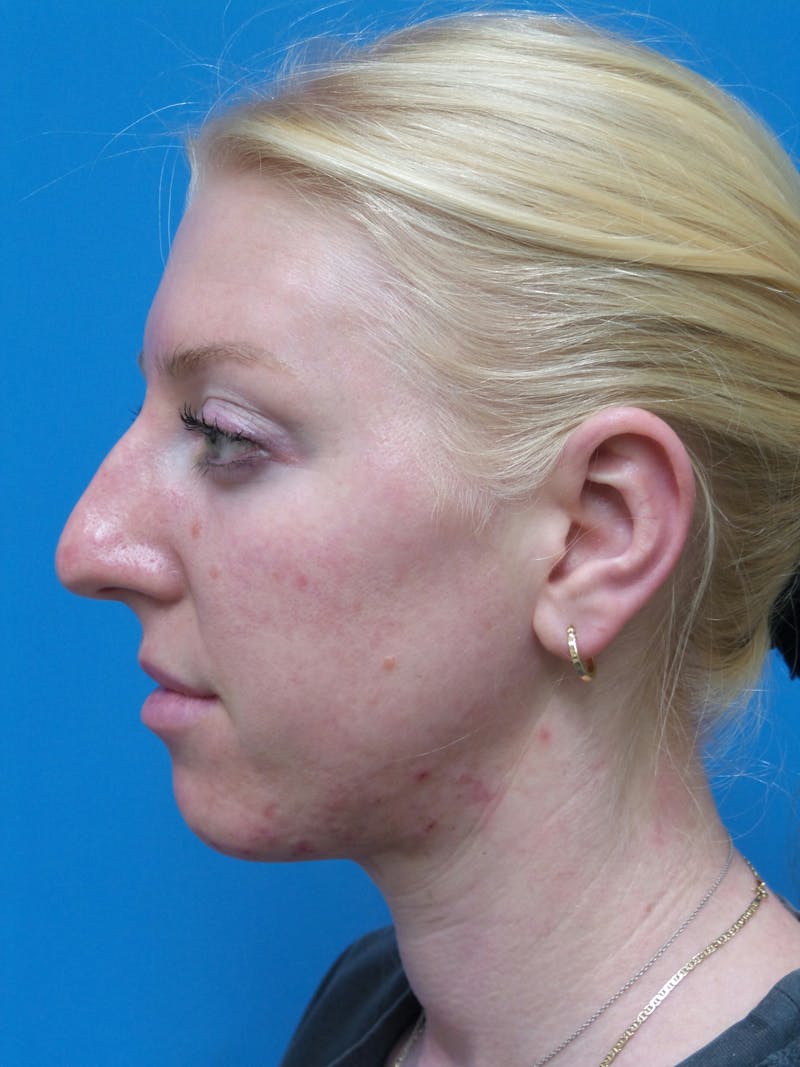 Rhinoplasty Before & After Gallery - Patient 399717 - Image 1