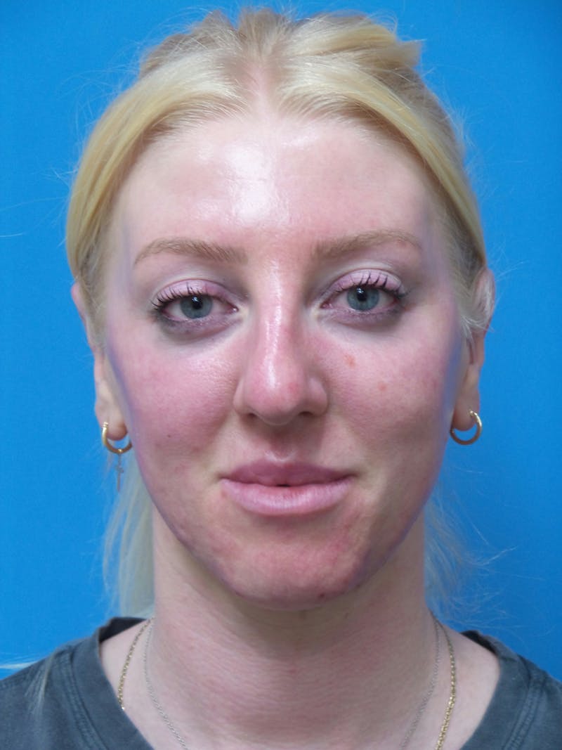 Rhinoplasty Before & After Gallery - Patient 399717 - Image 5
