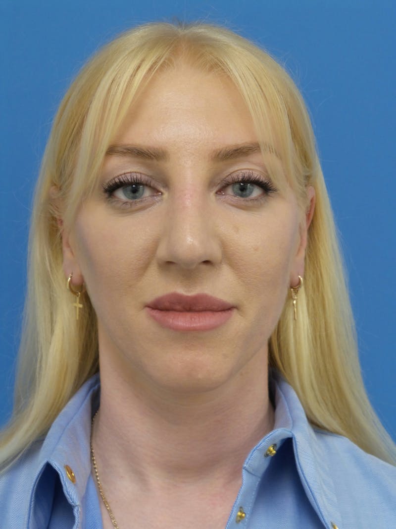 Rhinoplasty Before & After Gallery - Patient 399717 - Image 6