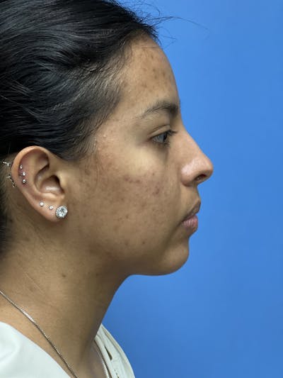 Rhinoplasty Before & After Gallery - Patient 388270 - Image 1