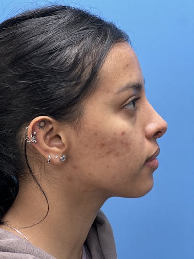 Rhinoplasty Before & After Gallery - Patient 388270 - Image 2