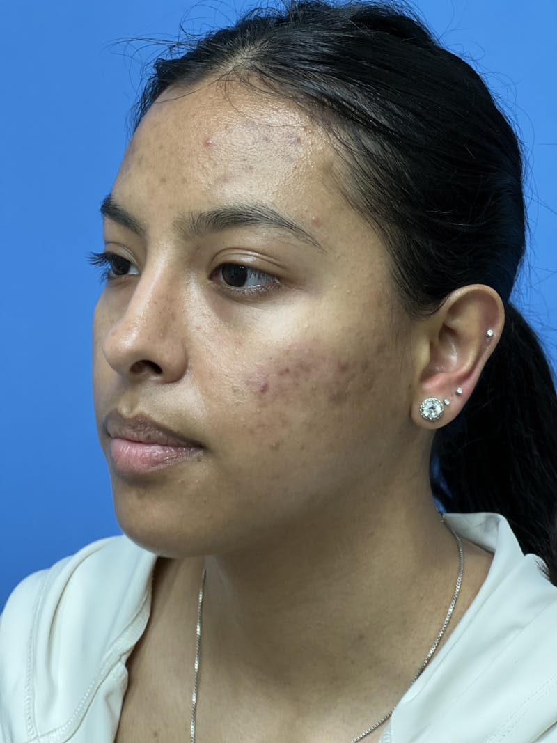 Rhinoplasty Before & After Gallery - Patient 388270 - Image 3