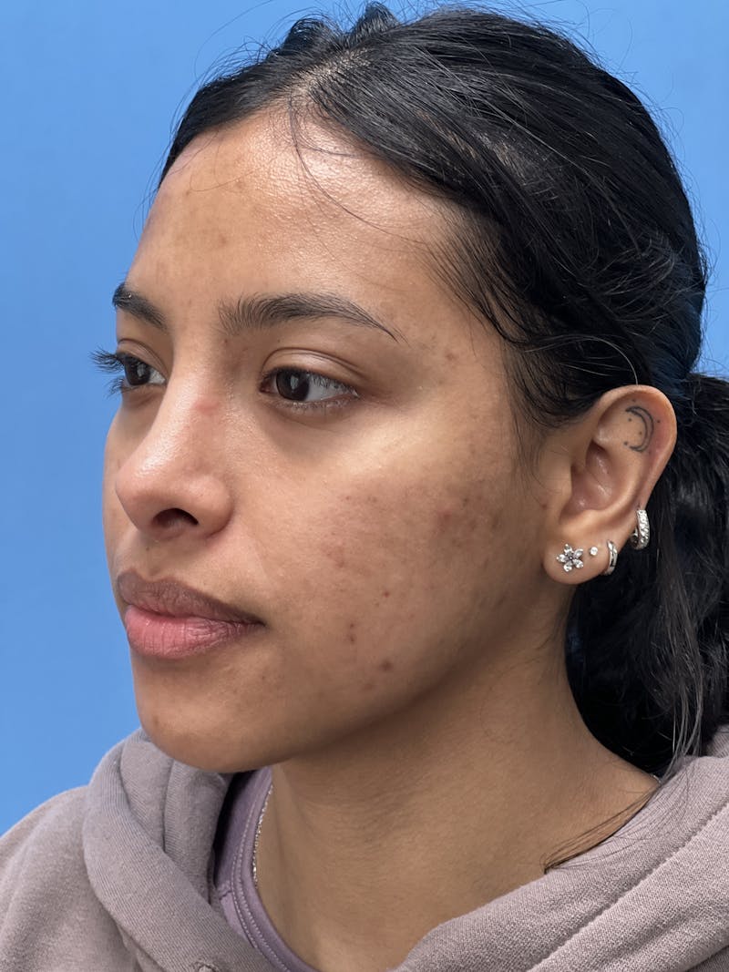 Rhinoplasty Before & After Gallery - Patient 388270 - Image 4