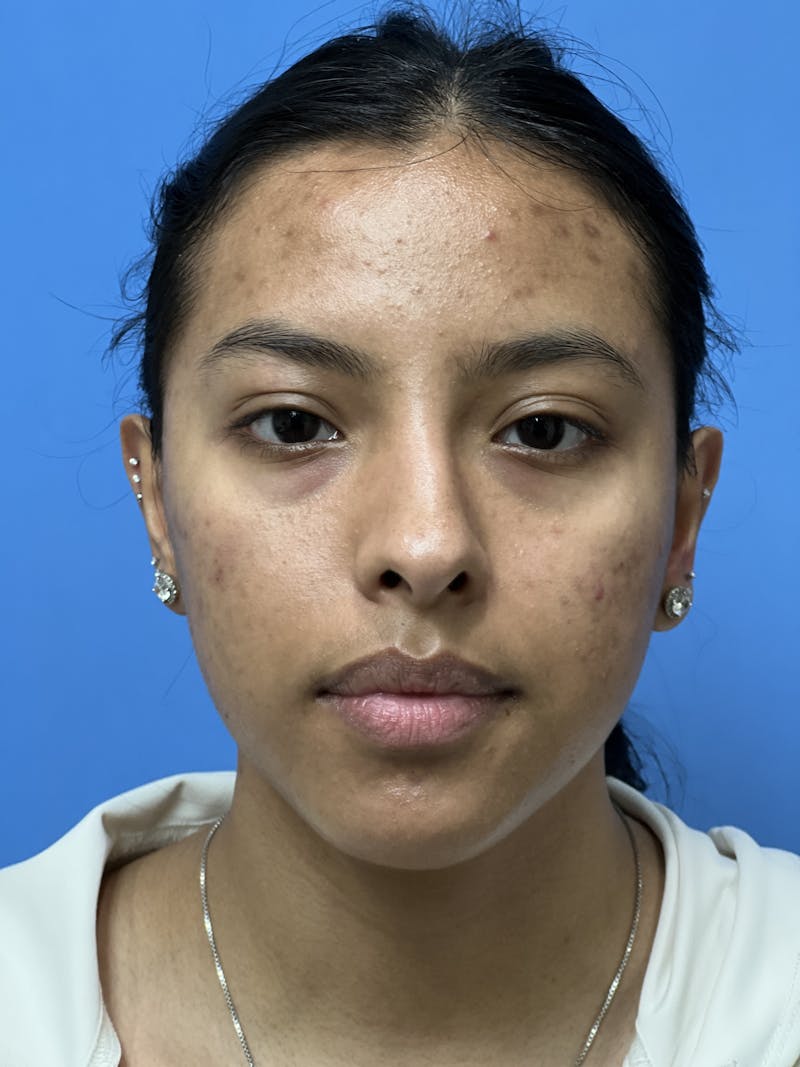 Rhinoplasty Before & After Gallery - Patient 388270 - Image 5