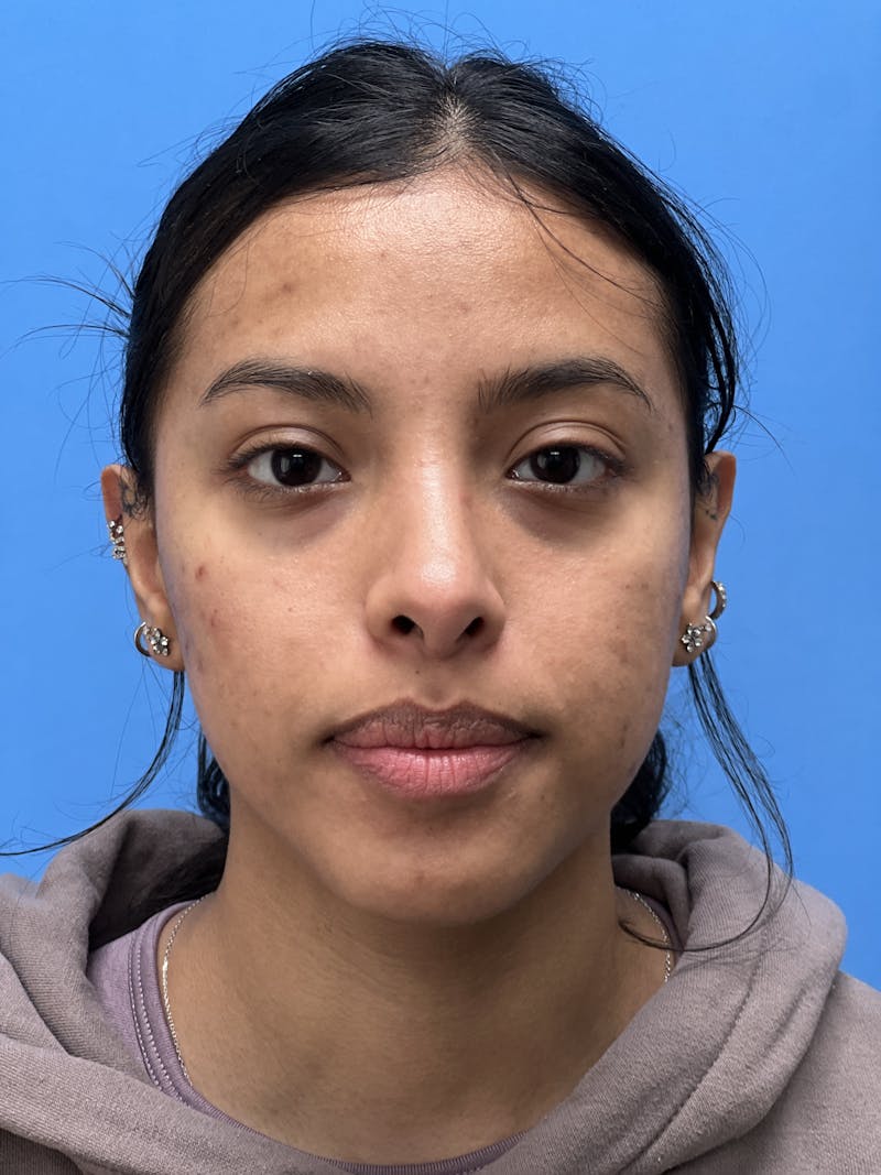 Rhinoplasty Before & After Gallery - Patient 388270 - Image 6