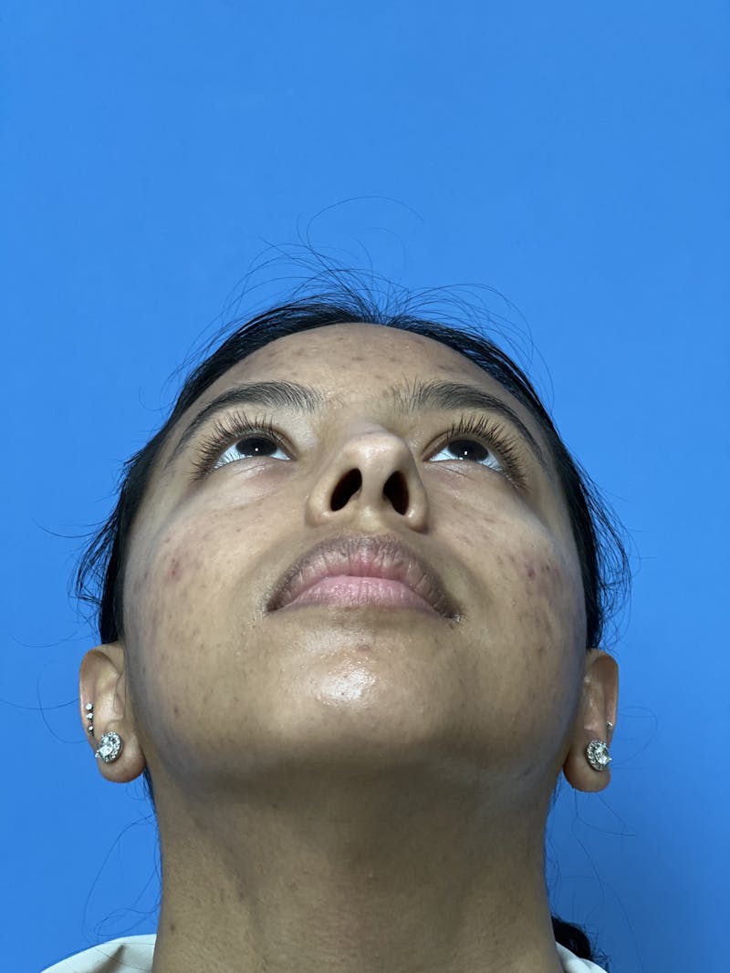 Rhinoplasty Before & After Gallery - Patient 388270 - Image 7