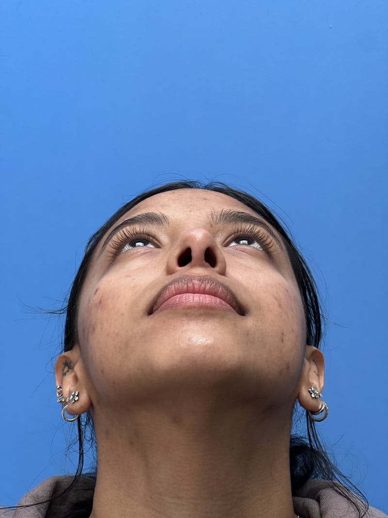 Rhinoplasty Before & After Gallery - Patient 388270 - Image 8