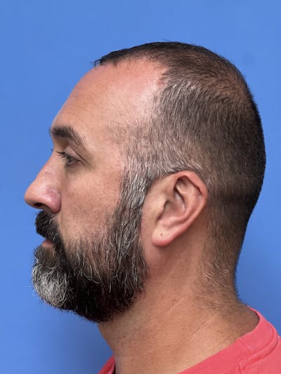 Rhinoplasty Before & After Gallery - Patient 625222 - Image 1