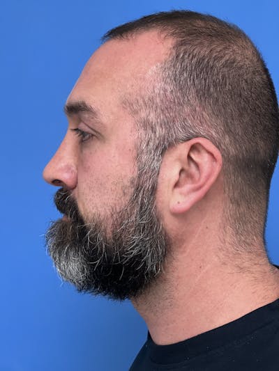 Rhinoplasty Before & After Gallery - Patient 625222 - Image 2