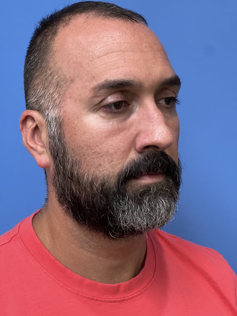 Rhinoplasty Before & After Gallery - Patient 625222 - Image 3