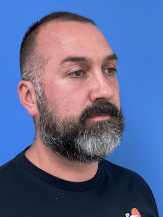 Rhinoplasty Before & After Gallery - Patient 625222 - Image 4