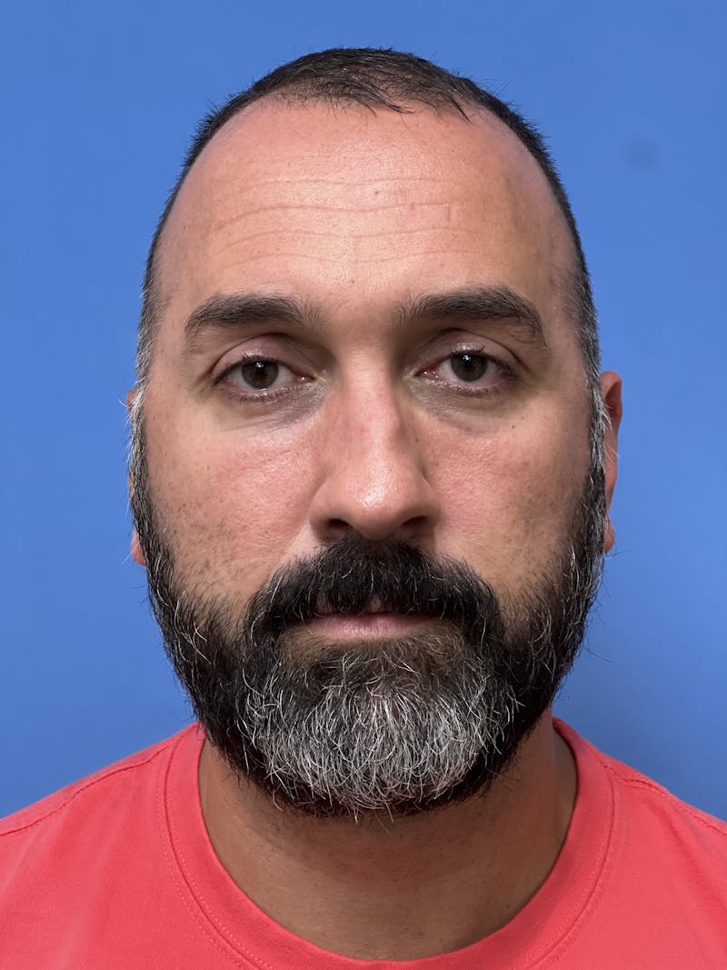 Rhinoplasty Before & After Gallery - Patient 625222 - Image 5