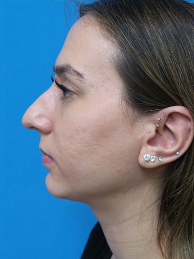 Rhinoplasty Before & After Gallery - Patient 275441 - Image 1