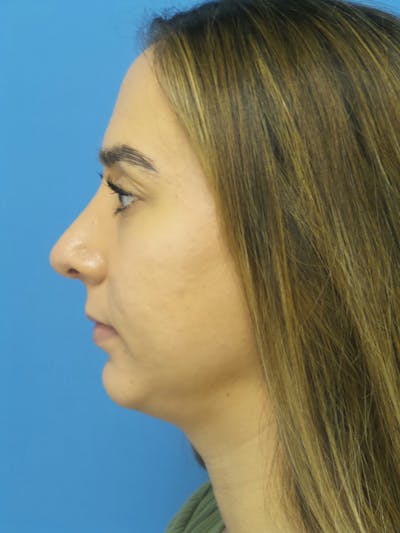 Rhinoplasty Before & After Gallery - Patient 275441 - Image 2