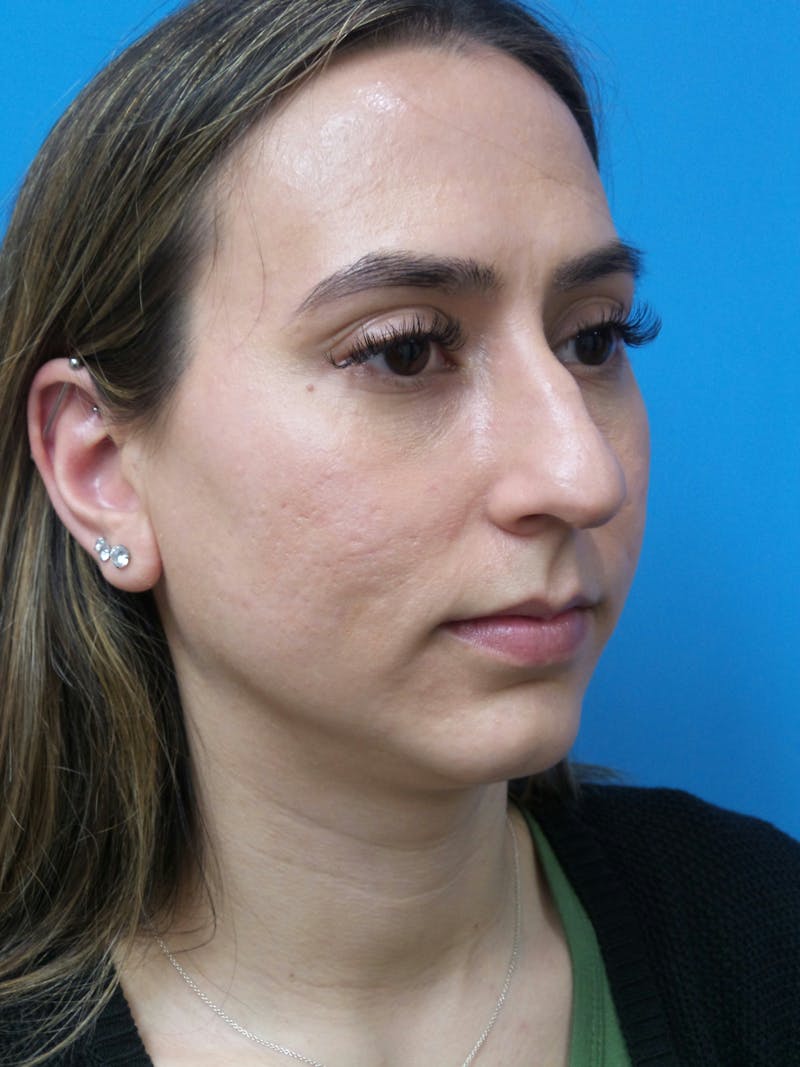 Rhinoplasty Before & After Gallery - Patient 275441 - Image 3