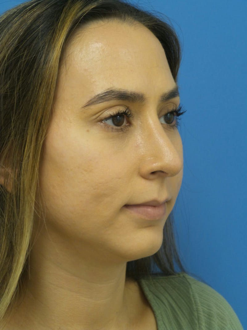 Rhinoplasty Before & After Gallery - Patient 275441 - Image 4