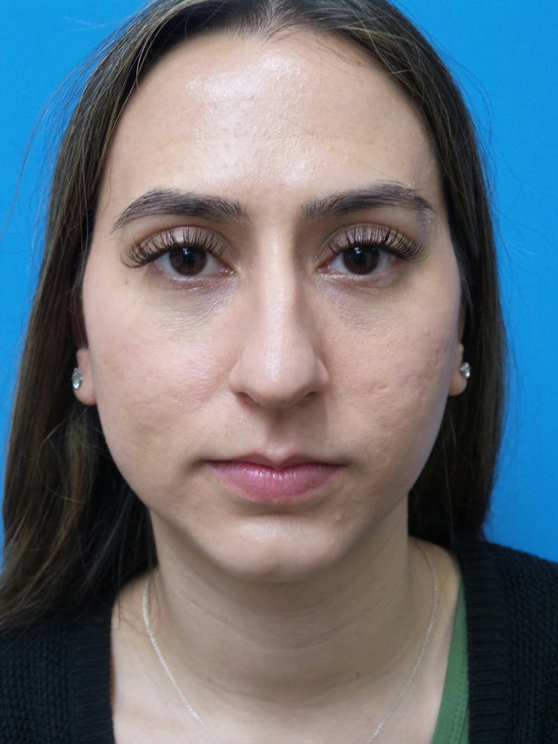 Rhinoplasty Before & After Gallery - Patient 275441 - Image 5