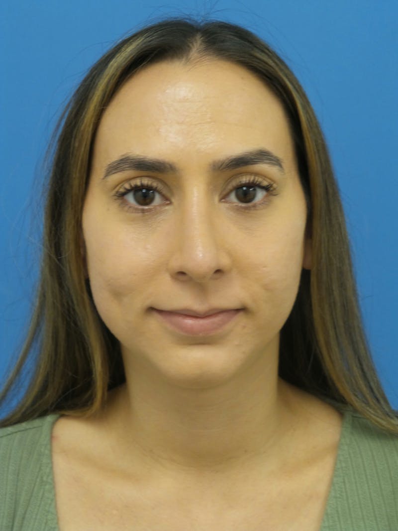 Rhinoplasty Before & After Gallery - Patient 275441 - Image 6