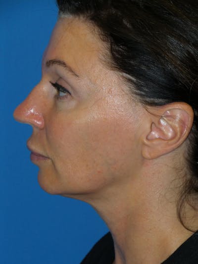 Rhinoplasty Before & After Gallery - Patient 300156 - Image 1