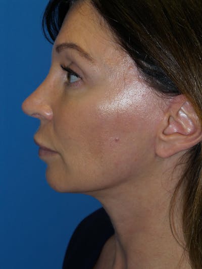 Rhinoplasty Before & After Gallery - Patient 300156 - Image 2