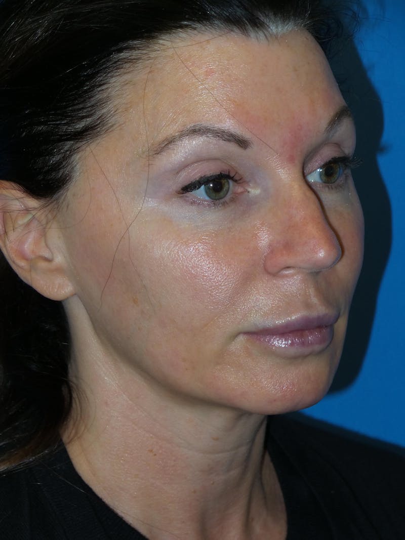 Rhinoplasty Before & After Gallery - Patient 300156 - Image 3