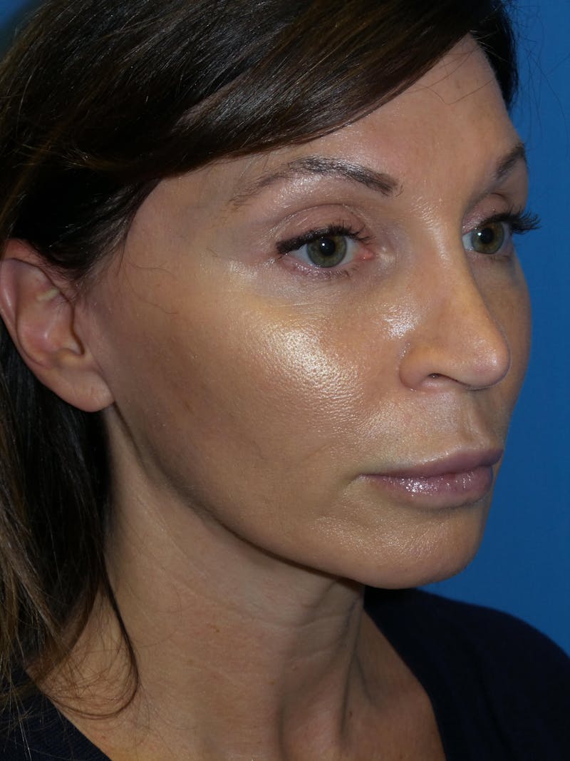 Rhinoplasty Before & After Gallery - Patient 300156 - Image 4