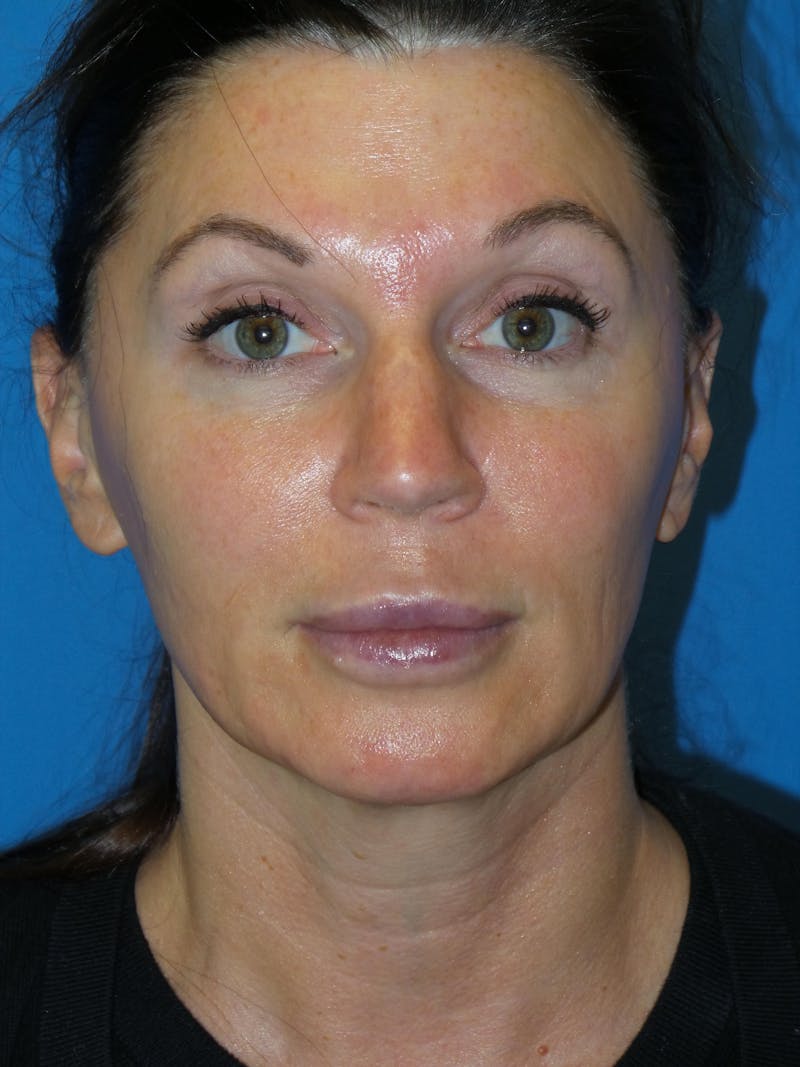 Rhinoplasty Before & After Gallery - Patient 300156 - Image 5