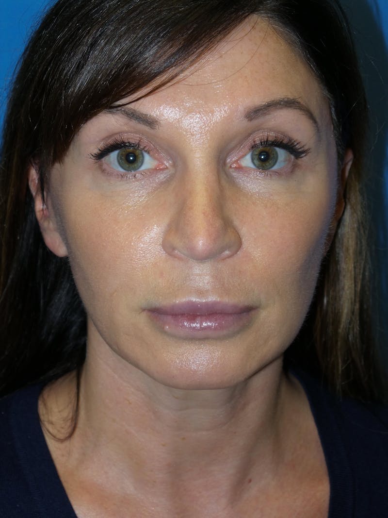 Rhinoplasty Before & After Gallery - Patient 300156 - Image 6