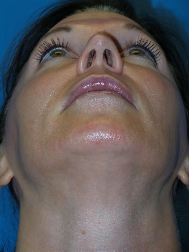 Rhinoplasty Before & After Gallery - Patient 300156 - Image 7