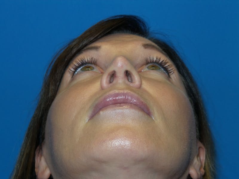 Rhinoplasty Before & After Gallery - Patient 300156 - Image 8