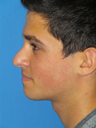 Rhinoplasty Before & After Gallery - Patient 352842 - Image 1
