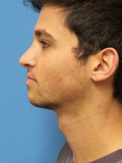Rhinoplasty Before & After Gallery - Patient 352842 - Image 2