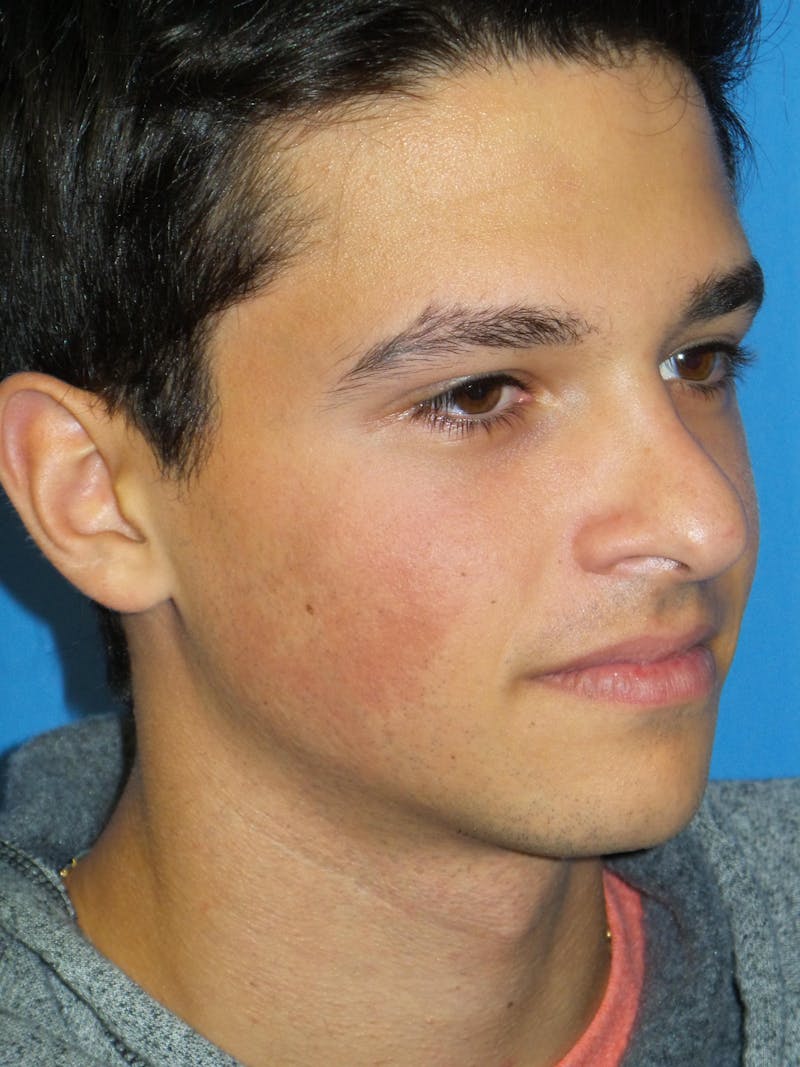 Rhinoplasty Before & After Gallery - Patient 352842 - Image 3