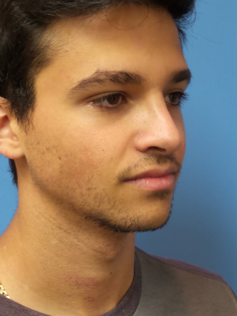 Rhinoplasty Before & After Gallery - Patient 352842 - Image 4