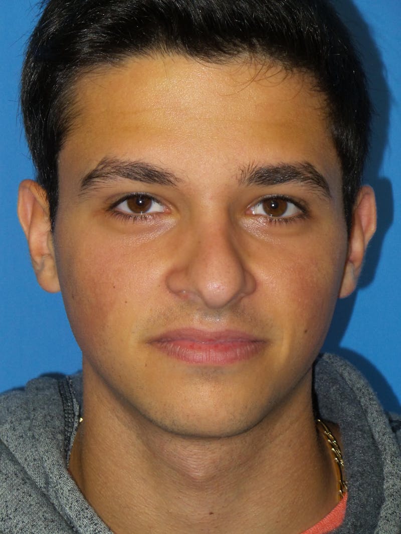 Rhinoplasty Before & After Gallery - Patient 352842 - Image 5