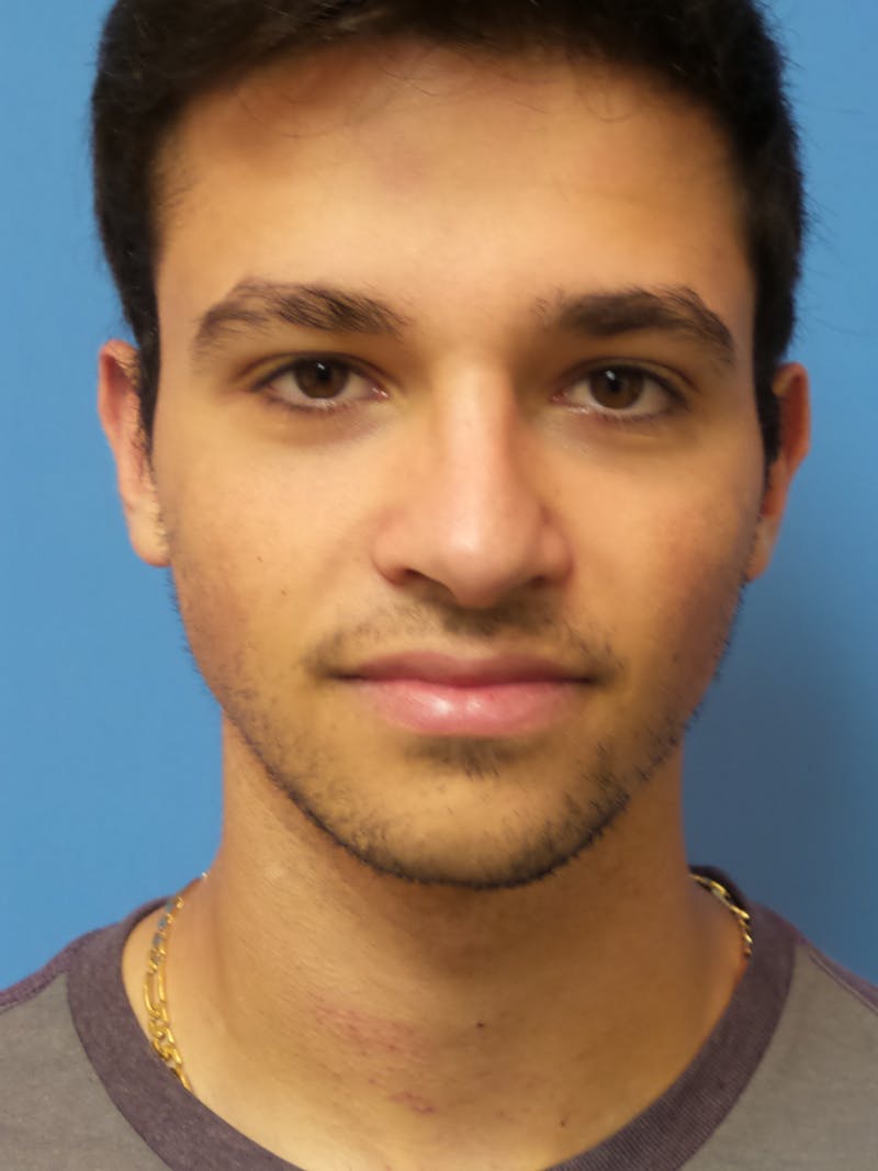 Rhinoplasty Before & After Gallery - Patient 352842 - Image 6