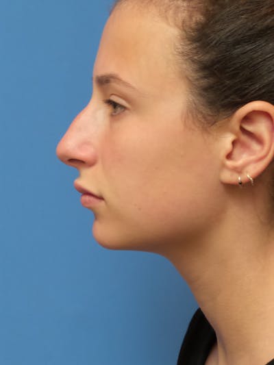 Rhinoplasty Before & After Gallery - Patient 222413 - Image 1