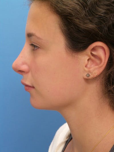 Rhinoplasty Before & After Gallery - Patient 222413 - Image 2