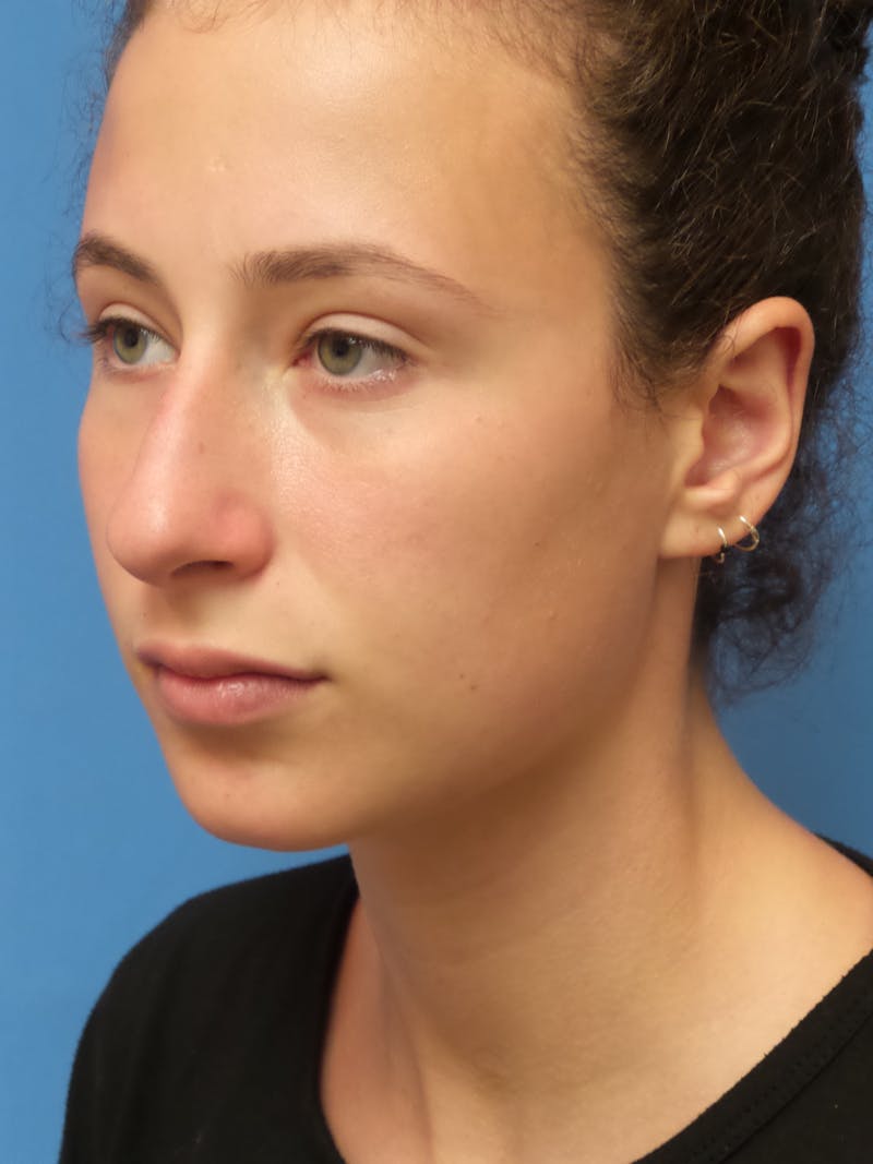 Rhinoplasty Before & After Gallery - Patient 222413 - Image 3