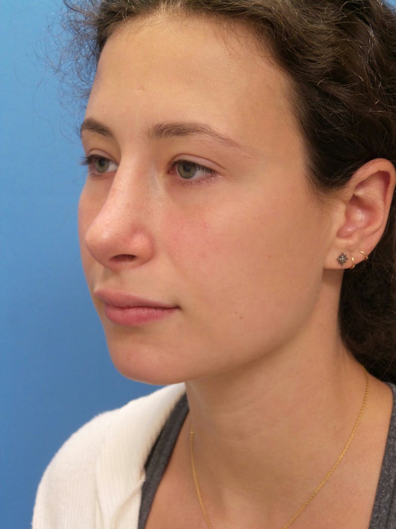 Rhinoplasty Before & After Gallery - Patient 222413 - Image 4