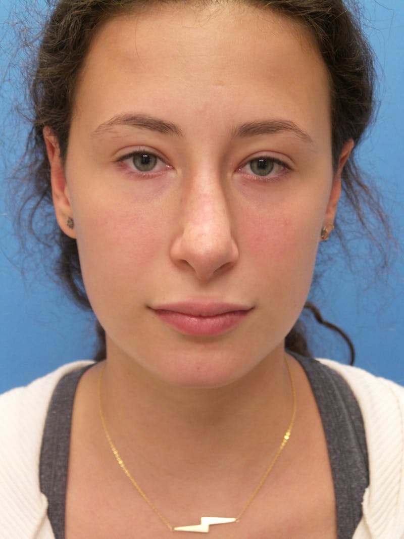 Rhinoplasty Before & After Gallery - Patient 222413 - Image 6