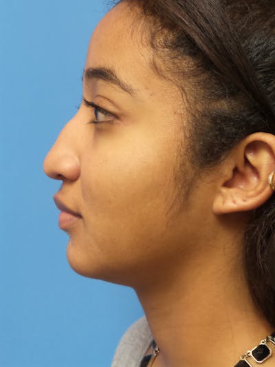Rhinoplasty Before & After Gallery - Patient 124371 - Image 1
