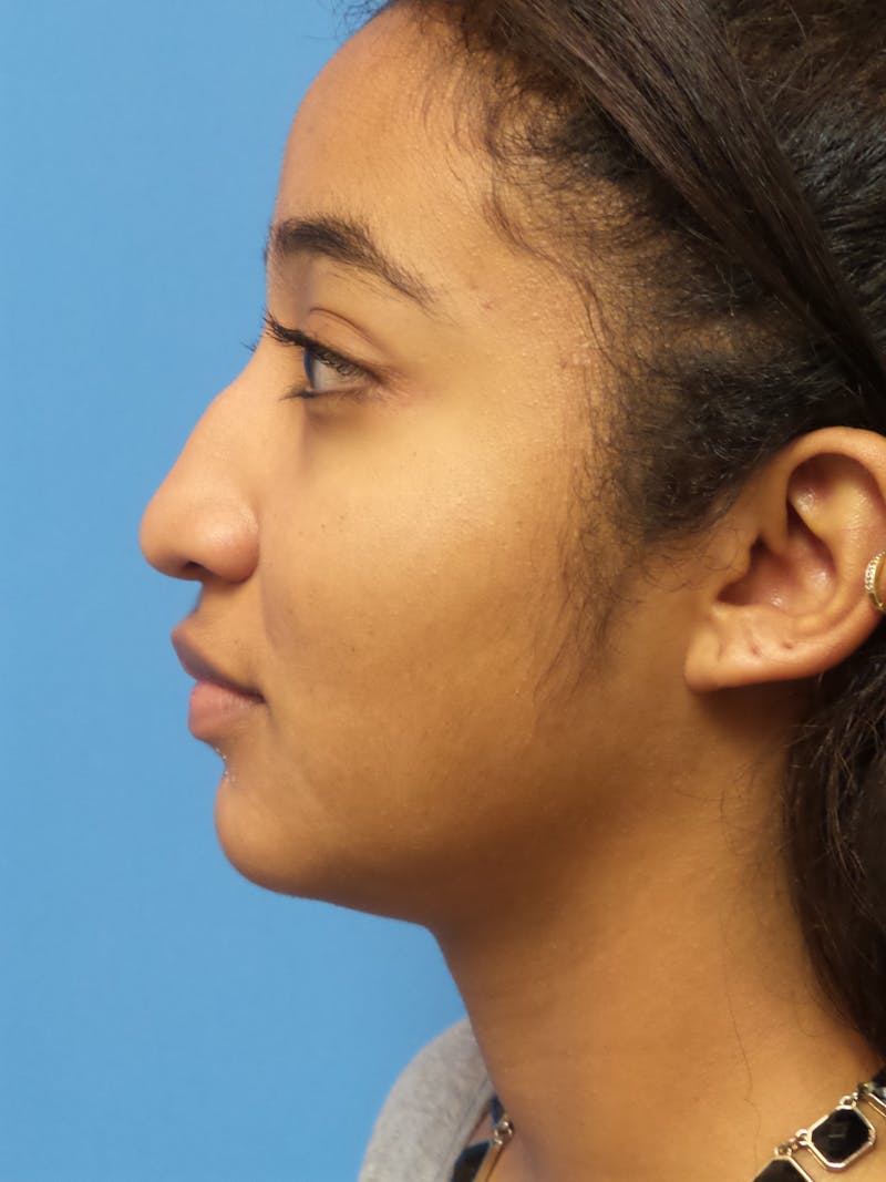 Rhinoplasty Before & After Gallery - Patient 124371 - Image 1