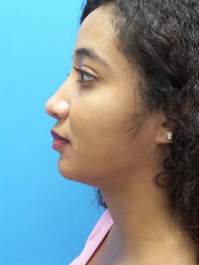 Rhinoplasty Before & After Gallery - Patient 124371 - Image 2