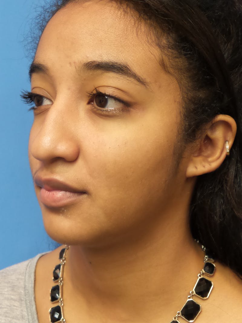 Rhinoplasty Before & After Gallery - Patient 124371 - Image 3