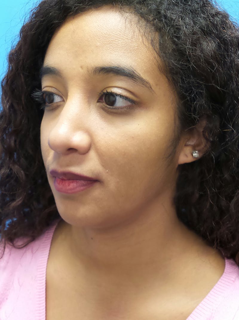 Rhinoplasty Before & After Gallery - Patient 124371 - Image 4