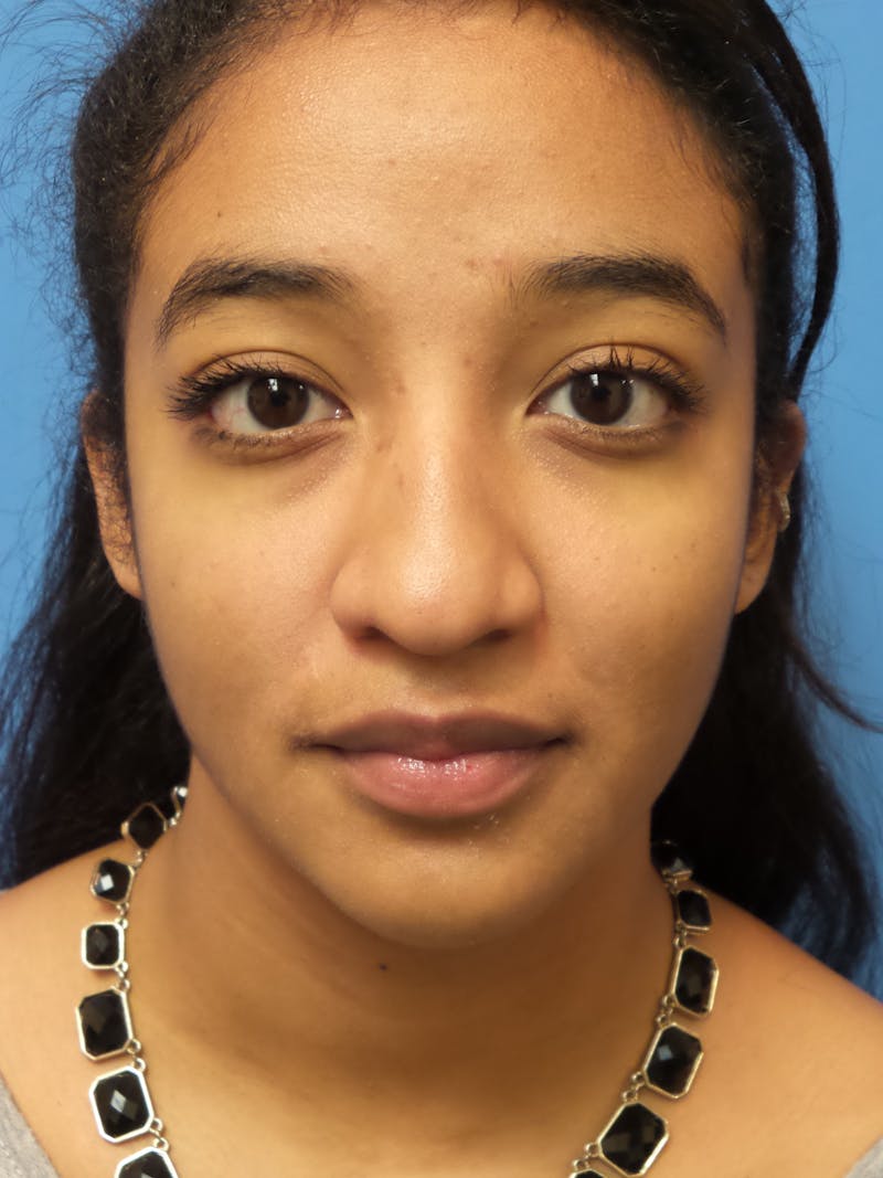 Rhinoplasty Before & After Gallery - Patient 124371 - Image 5