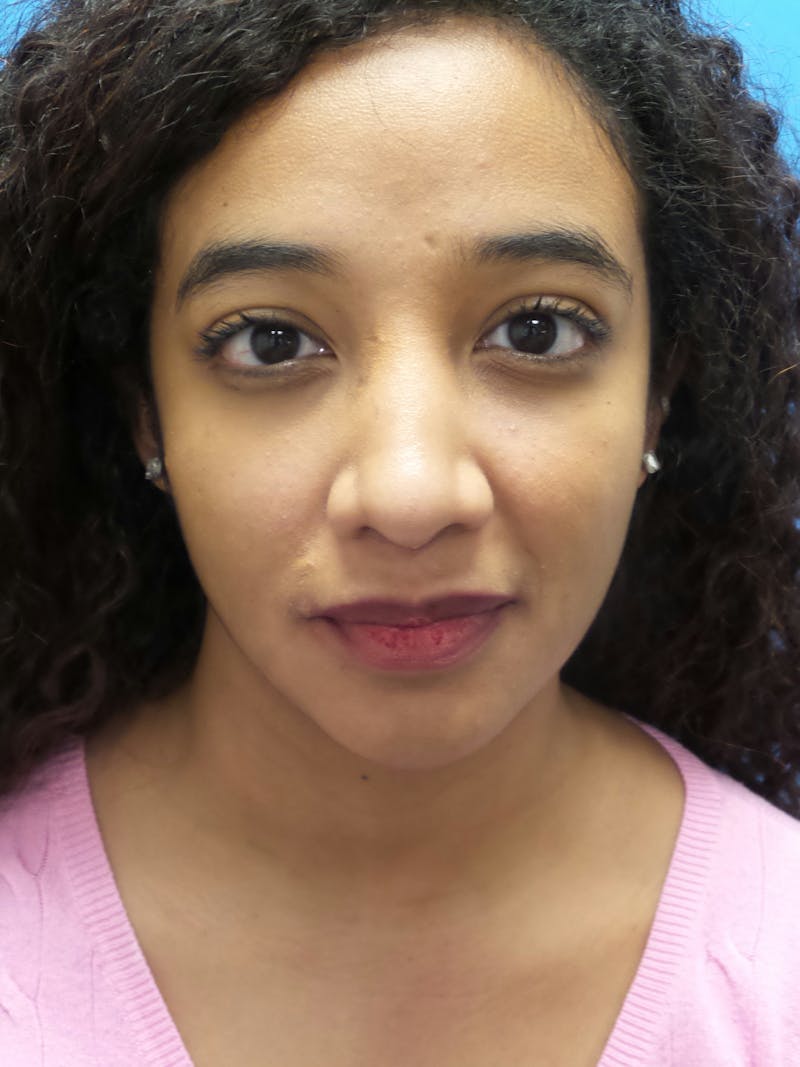 Rhinoplasty Before & After Gallery - Patient 124371 - Image 6